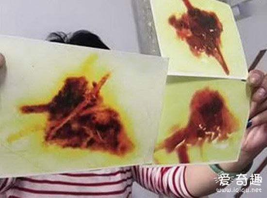 女子盖死人被子致寄生虫上身4年  口吐黑虫下身奇痒_见识多