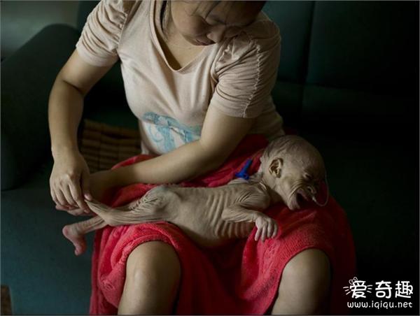 女婴天生患罕见病：一年只长一两肉瘦得皮包骨